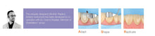 LM-Arte™ Replica Anterior ES
